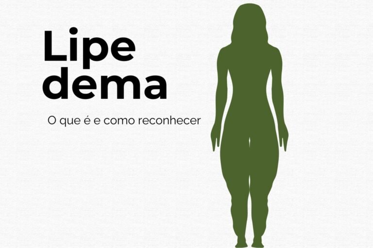 Lipedema: o que é, sintomas, causas e tratamento em São Paulo