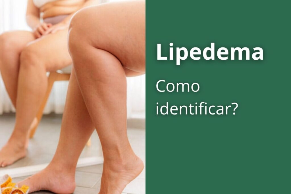 Lipedema: como identificar nos primeiros sinais
